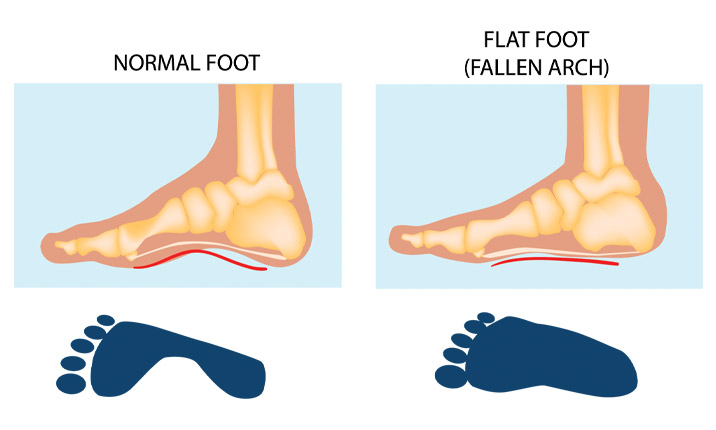 children-flat-feet-causes